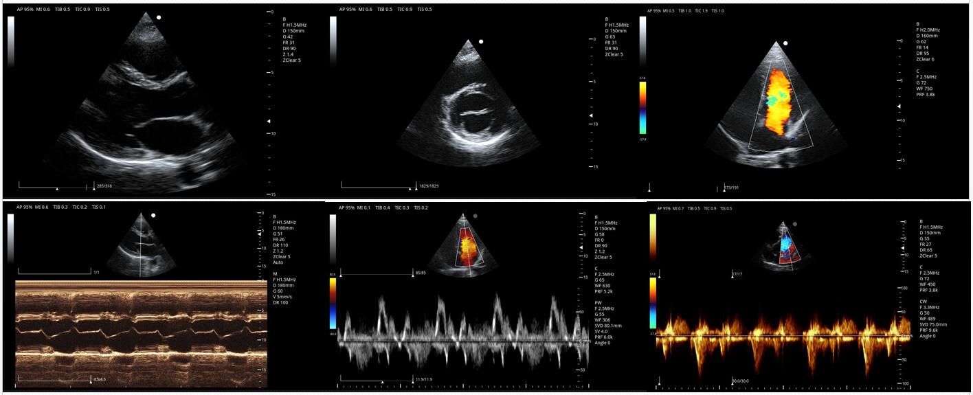 R&eacute;sultat Doppler couleur