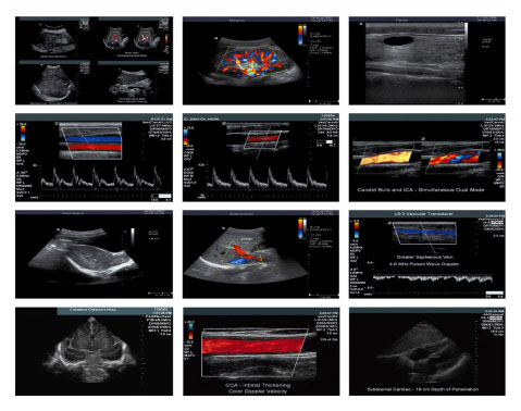 Scanner à ultrasons numérique mobile avec chariot (WHY40)